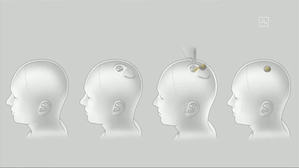 Interface da Neuralink cérebro-computador é implantada na região do cérebro responsável por controlar as intenções de movimento!